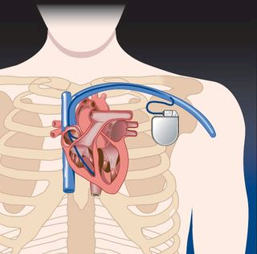 tekening van een pacemaker in het lichaam