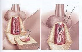 vernauwing plasbuis doorsnede